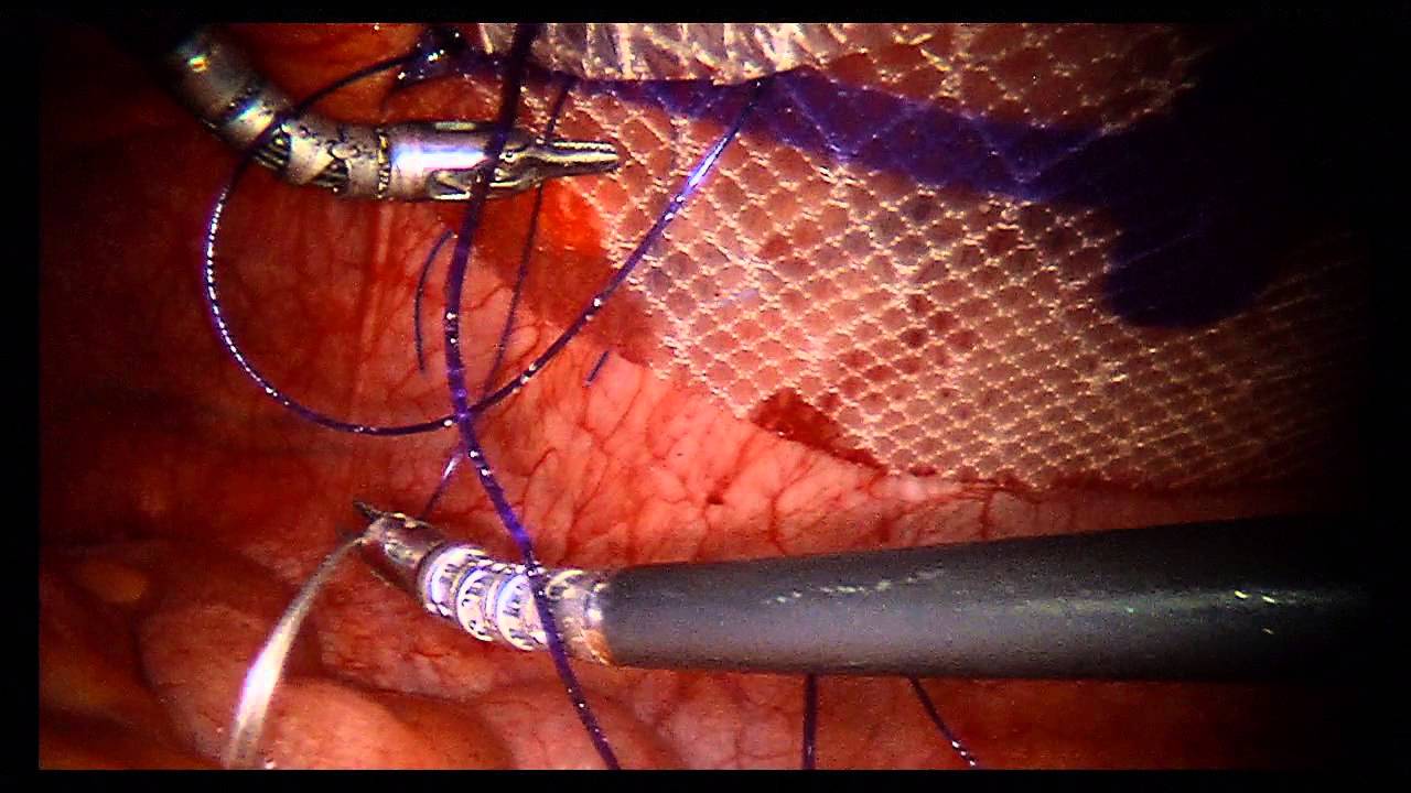 Robotic Ventral Hernia Repair with Mesh, No Tacks - YouTube