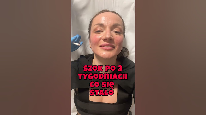 BOTOKS NA BRUKSIZM PO 3 tygodniach 😳 szok