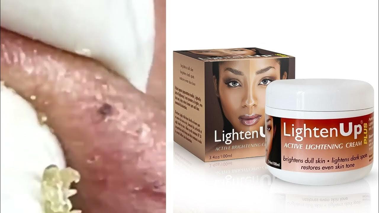 why-do-you-get-dark-spots-on-your-skin-youtube
