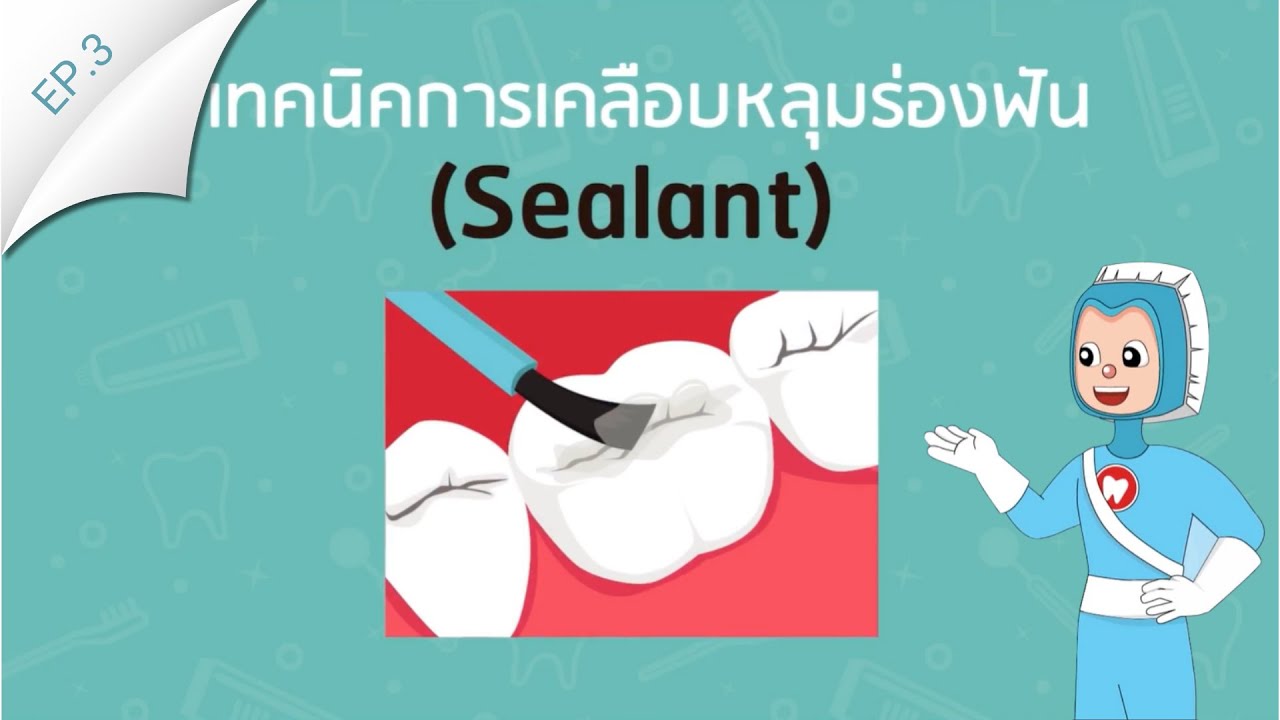 เทคนิคการเคลือบหลุมร่องฟัน (Sealant) | EP.3
