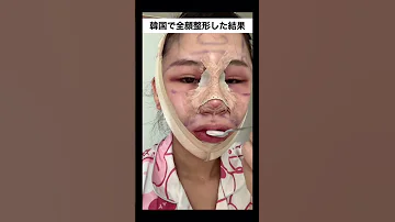 韓国で全顔整形した結果 