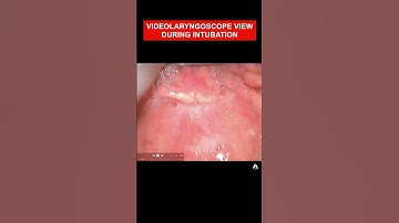 Video laryngoscopy view of the Larynx during intubation | #shorts #anatomy #airway #CMAC