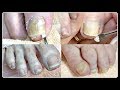 👣 #2 POV Salon Pedicure Compilation Big Toenail Cleaning 👣✔