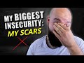 Showing my hs scars for the first time