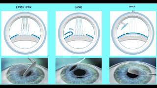 How Laser Eye Surgery works? What are different types of Laser Eye Surgery Treatments? Part 2 of 10