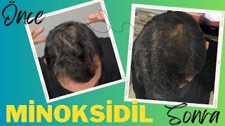Dökülen saç nasıl çıkar | Minoksidil Sprey |  6 Aylık süreç | Saç dökülmesi çözümü