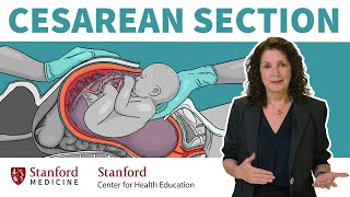 What is a cesarean section? OB\/GYN answers 13 common questions about c-sections | Stanford