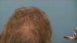 Hair Transplant | Results - 7218 Grafts - Hasson & Wong