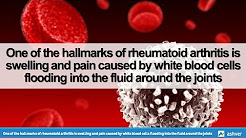 One of the hallmarks of rheumatoid arthritis is swelling and pain caused by white blood cells.