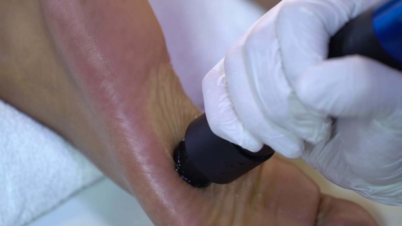 İnceler Medikal MODUS ESWT shock wave therapy  Genel Uygulama Videoları