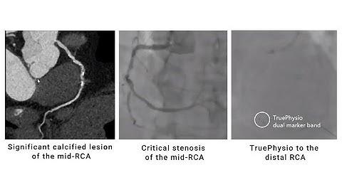 FFR measurements in a multi-vessel disease case with heavy calcification
