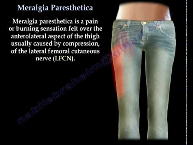 Meralgia Paresthetica Everything You Need To Know Nabil 52 OFF meralgia-paresthetica-everything-you-need-to-know-nabil-52-off