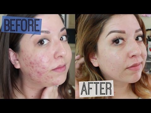 How I Cured My Acne!