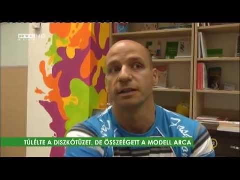 RTL KLUB - Fókusz - Túlélte a diszkótüzet, de összeégett a modell arca - 2014-06-03