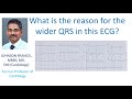 ECG with Wide QRS