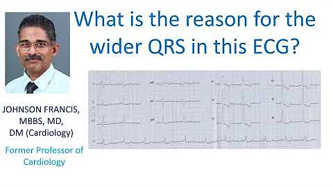 ECG with Wide QRS