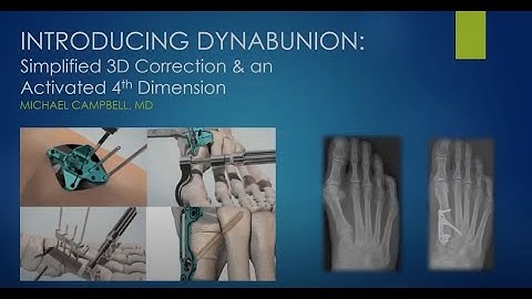 Introducing DynaBunion™ - FOOTInnovate Webinar with Michael Campbell, MD