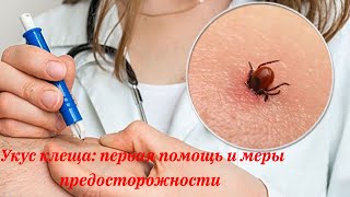 Укус клеща: первая помощь и меры предосторожности.