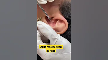 Прыщи , комедоны в ушах причины в описании