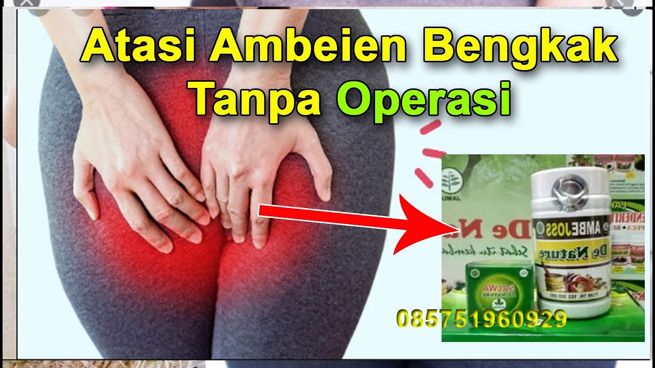 Cara Mengatasi Ambeien Bengkak Tanpa Operasi