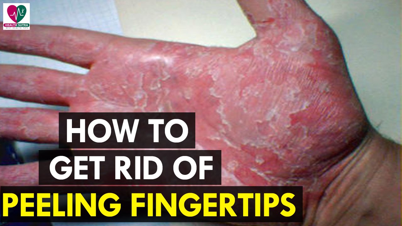 How To Get Rid Of Peeling Fingertips Health Sutra YouTube