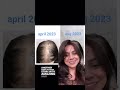 REAL PCOS Hair Growth SUCCESS Story  With Amazing Hair Saviour✨ #PCOS #hairgrowth #hairloss