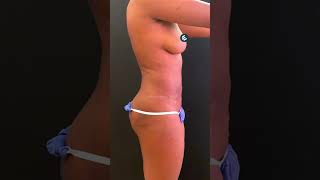 Liposuction And Brazillian Butt Lift (BBL) Plastic Surgery shorts