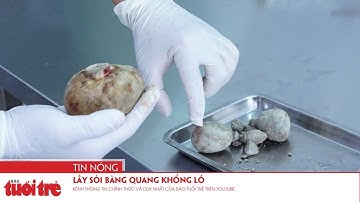 Lấy sỏi bàng quang khổng lồ