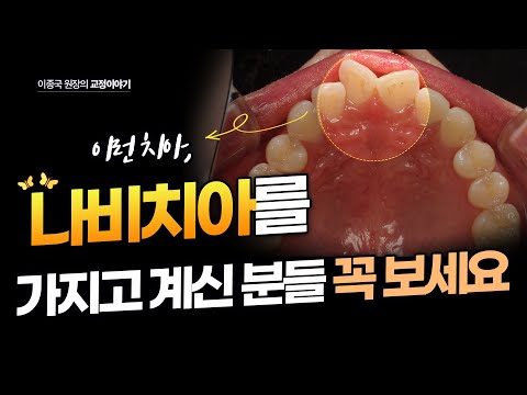 나비치아 치료방법 총정리 부분교정 투명교정 전체교정 발치교정 