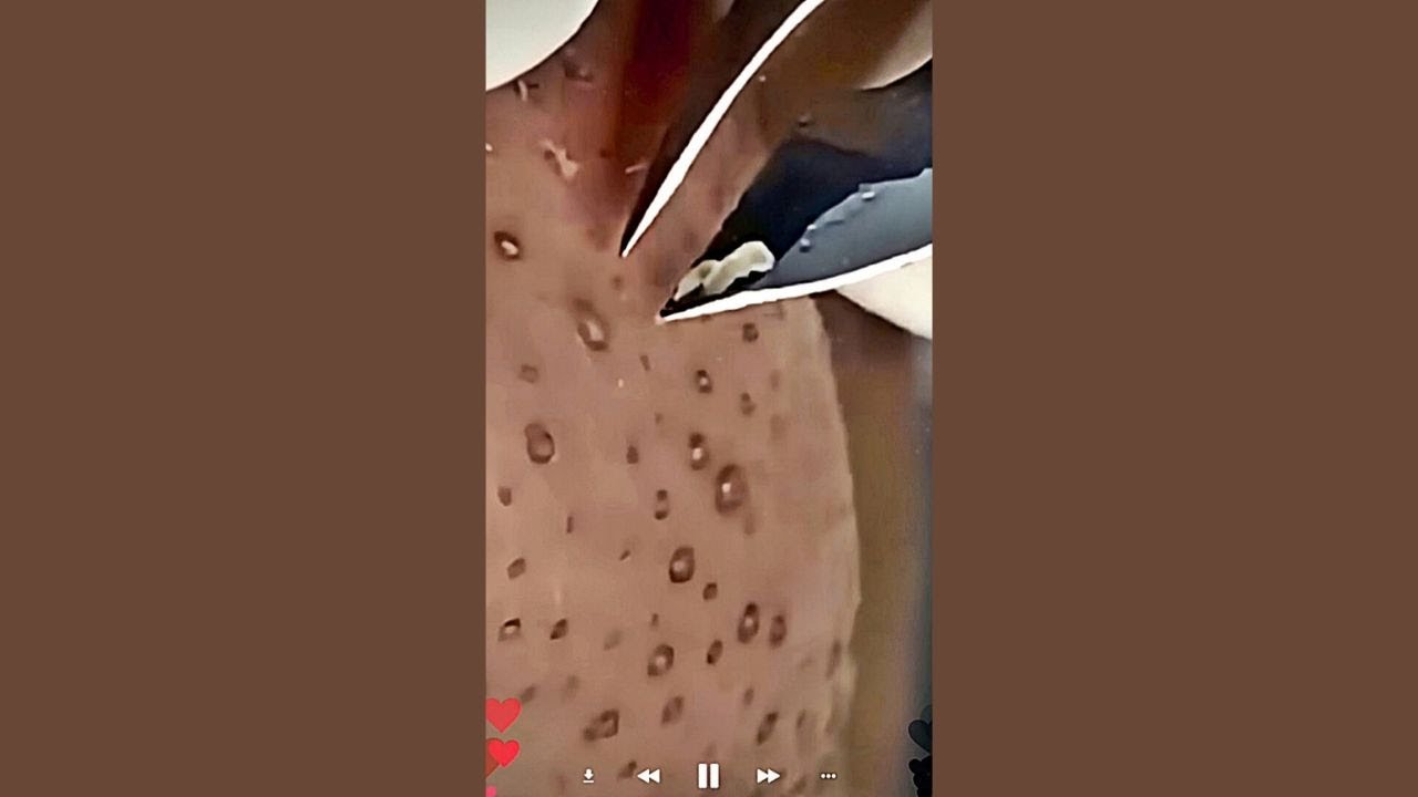 Skincare | Blackheads Removal 