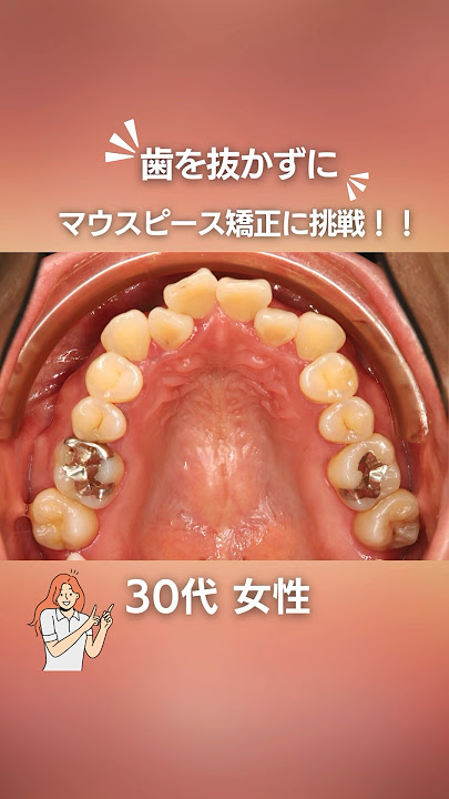 ワイヤーではなくマウスピース矯正で治したい方必見#shorts #歯列矯正 #マウスピース矯正#インビザライン