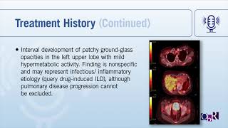 Case Study: HER2+ Metastatic Breast Cancer in a Post-Menopausal 57-year-old Female