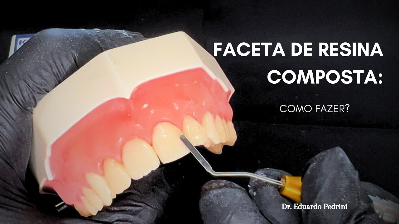 Faceta direta em Resina Composta