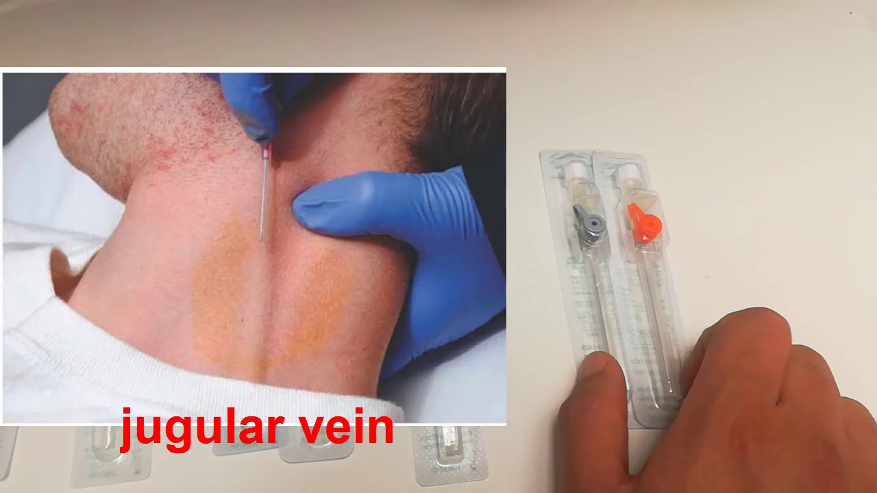 انواع الكانيولات