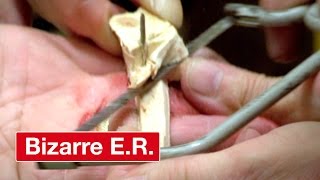 Man Nails Plank Of Wood To Himself- Bizarre ER