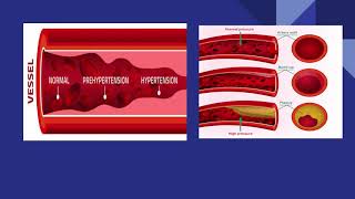 Jaskiran Kaur Community Health Project Hypertension