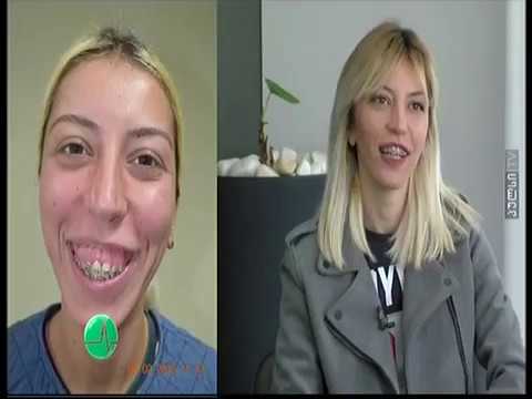 ორთოგნათიული ქირურგია -  დავით ბახტურიძე Orthognathic Surgery - BAKHTURIDZE DAVIT