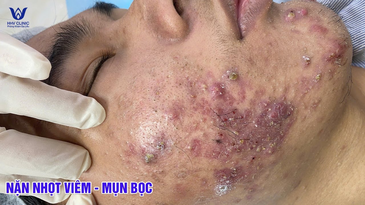 Cận cảnh mụn viêm nặng trên má sai lầm nào khiến da ngày càng tệ.