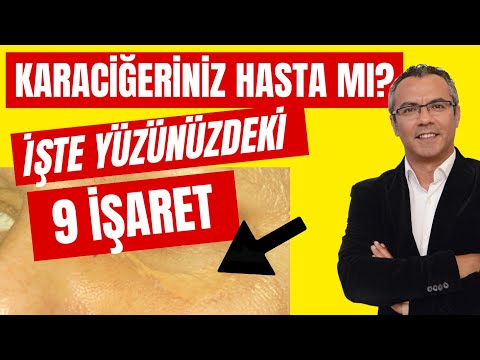 Karaciğer Hastalığının Yüzümüzdeki