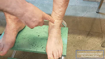 Come si cura l'ulcera alla caviglia?