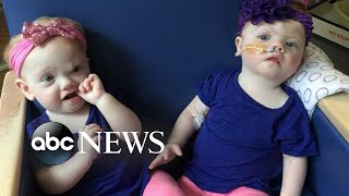 Family shares update on formerly conjoined twins following separation surgery