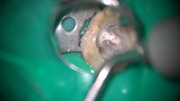 Removal of a nonvisible broken file/見えない破折器具の除去