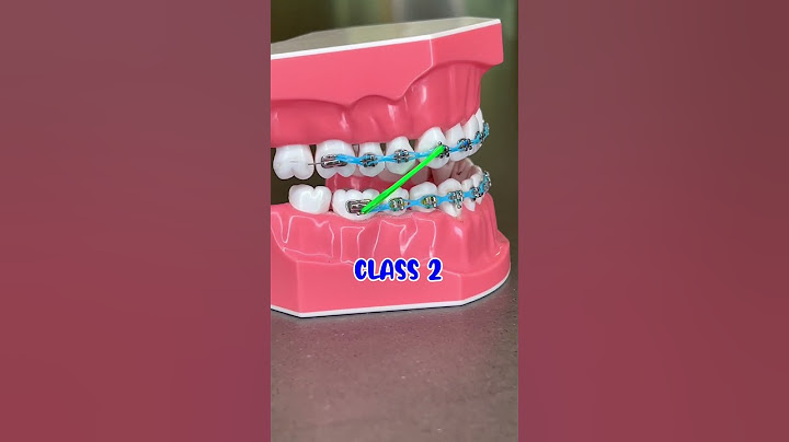 COMMON WAYS TO WEAR RUBBER BANDS WITH BRACES 🦷 ORTHODONTIST EXPLAINS