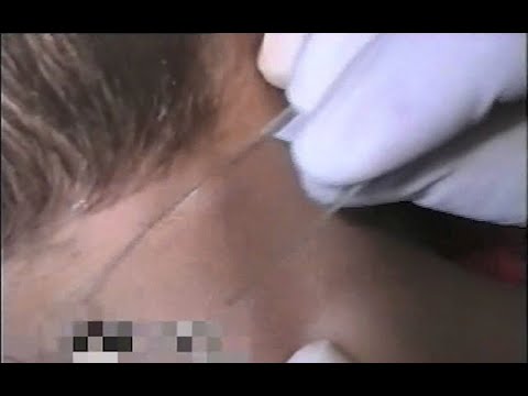 Video: Screening For Varicella Zoster I Graviditet