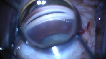 Hydrus Microstent Implantation