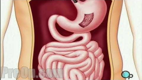 Endoscopy - Upper GI Surgery PreOp® Patient Education