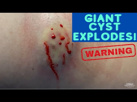 Watch This Giant Cyst SQUIRT! 😲