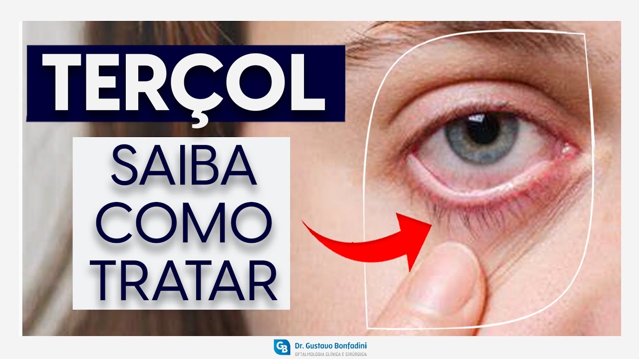 Terçol: saiba causas, sintomas, tratamento e se é contagioso