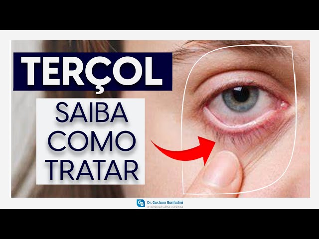 Série Doenças Oculares: #2 TERÇOL (HORDÉOLO)