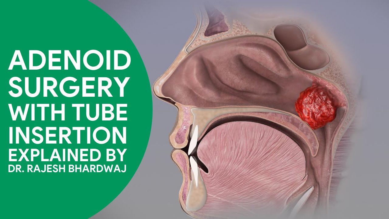 Adenoidectomy Before And After